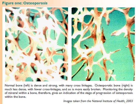 Osteoporosis