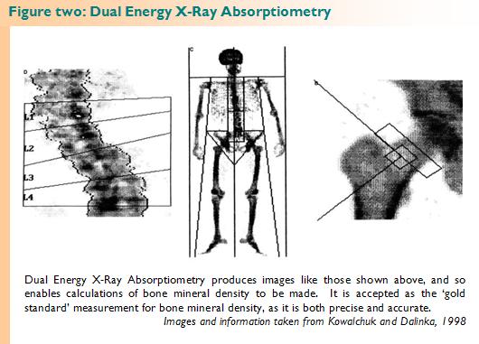 Dual Energy X-Ray Absorptiometry